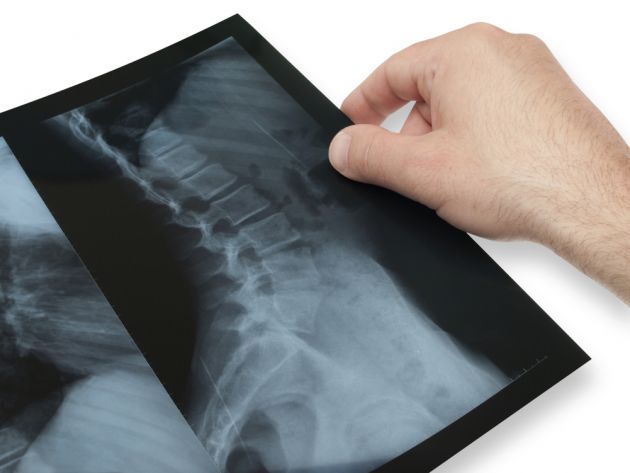 escoliosis-en-los-ninos-2